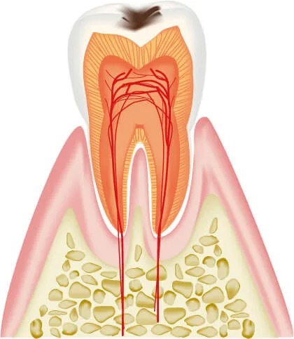 C1：エナメル質が溶け表面に穴があいている状態
